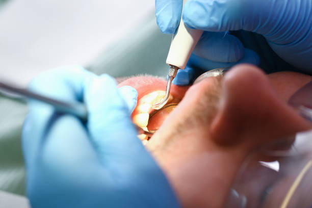Best Dental Abscess Treatment in Derby, KS